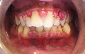 "Gingivitis (crop)" by Lesion - Own work. Licensed under CC BY-SA 3.0 via Wikimedia Commons - http://commons.wikimedia.org/wiki/File:Gingivitis_(crop).jpg#/media/File:Gingivitis_(crop).jpg